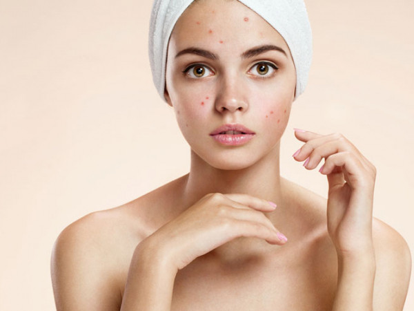 Làm thế nào để tránh được việc bị mụn “tùm lum” ở tuổi dậy thì đây nhỉ?