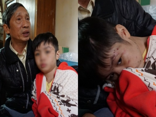 Bé trai 10 tuổi bị cha và mẹ kế đánh gãy tay: "2 năm rồi con mới được ăn bát phở"