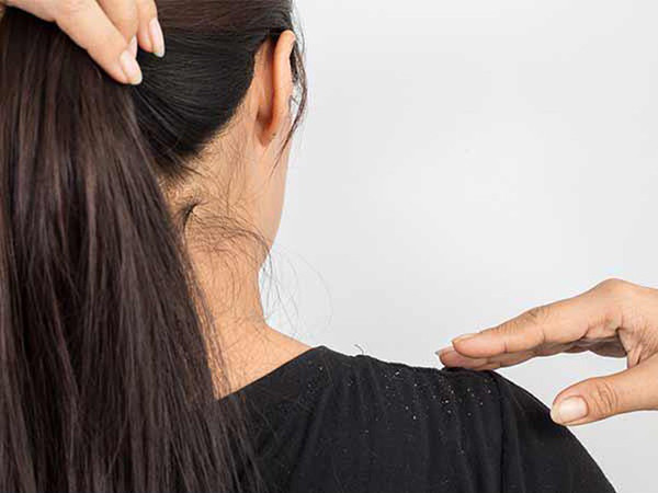 Đi tìm nguyên nhân khiến đầu bạn lúc nào cũng lấm tấm gàu vào mùa Đông