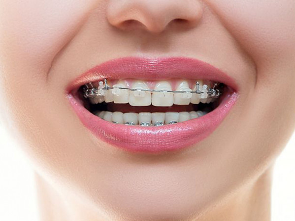 Giúp bạn chuẩn bị “hành trang” bước vào thế giới “mắc cài”