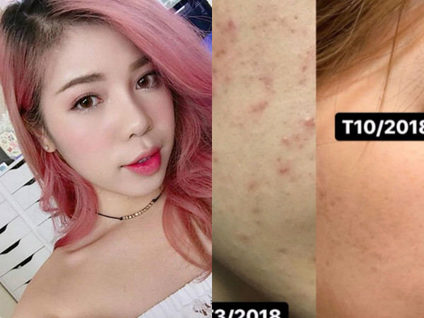 "Thánh son" Changmakeup mất tích hàng tháng trời vì mụn mọc dày đặc