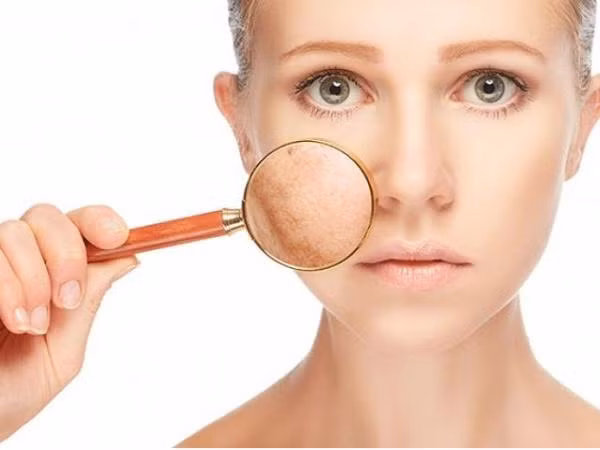 Bí quyết giải cứu ngay làn da bị xì-trét chỉ trong 5 nốt nhạc
