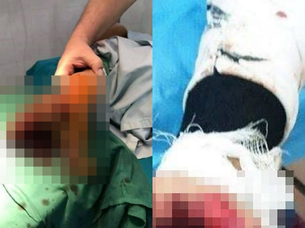 Nam sinh 17 tuổi vĩnh viễn mất đi bàn tay chỉ vì vừa dùng điện thoại vừa sạc