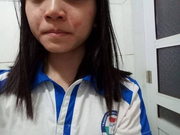 Hàng chục học sinh nổi mẩn ngứa, phát ban phải nghỉ học sau khi trường phun thuốc diệt muỗi