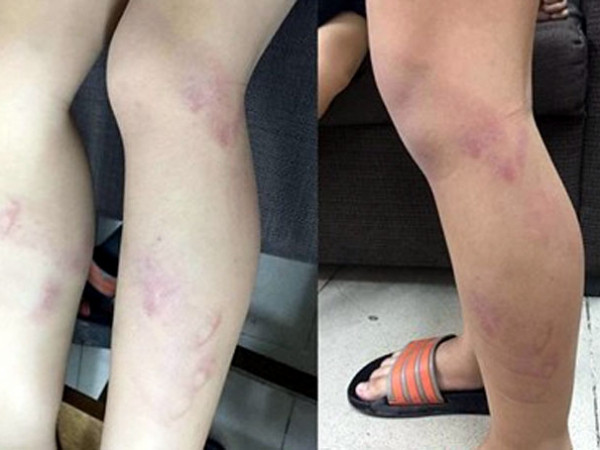 Hà Nội: Cảnh cáo giáo viên dùng thước đánh tím chân học sinh