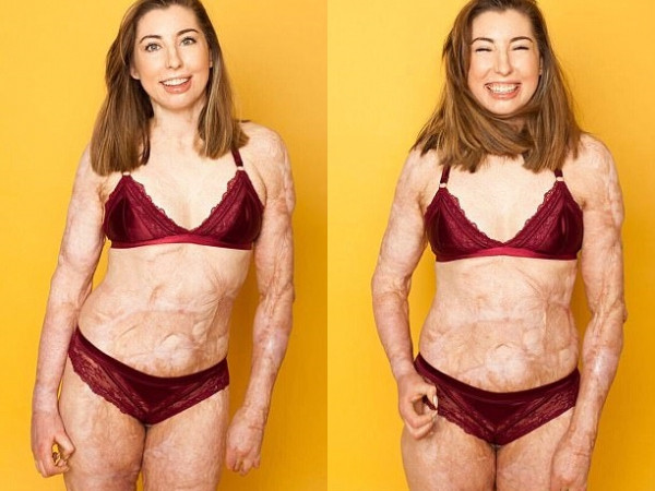 Cô gái tự tin này đã chứng minh một điều: Có sẹo chưa chắc đã là xấu!