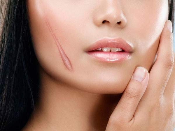 Hô biến vết sẹo thành “hư không” - các bước “dưỡng bỏng” cho các “xui xẻo gia”