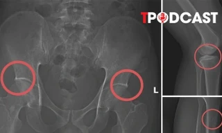 NÓNG 28/11: Vụ dùng búa đục xương để trục lợi bảo hiểm: Hé mở thủ đoạn của Tạ Minh Châu