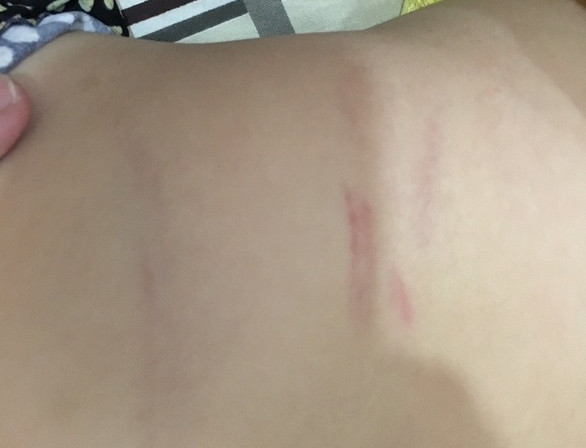 Vết xước và bầm trên người bé P. sau khi phụ huynh phát hiện - Ảnh do người nhà bé P. cung cấp