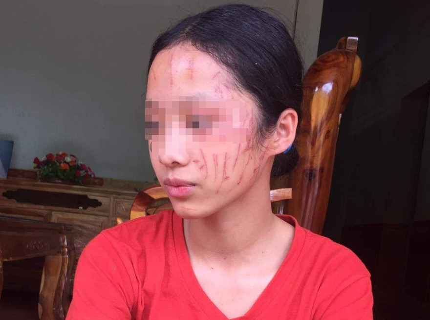 Trên mặt em H. có nhiều vết cào cấu, sưng đỏ.