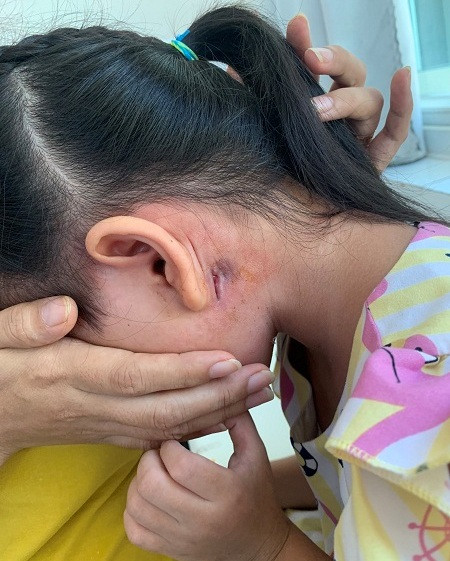 Ghi nhận bệnh nhân nhiễm vi khuẩn Whitmore thứ 2 tại Bình Định.