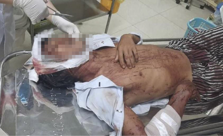 Nạn nhân hiện đang được cấp cứu tại BVĐK tỉnh Bình Định.