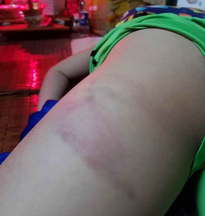 Phụ huynh tố giáo viên chủ nhiệm đánh con mình bầm tím cơ thể. Ảnh: Người nhà đăng tải