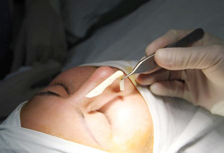 Teen Việt trong "cơn lốc" phẫu thuật thẩm mĩ