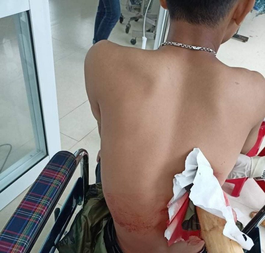Nam thanh niên bị thanh cây keo đâm xuyên người. Ảnh: (FaceBook)