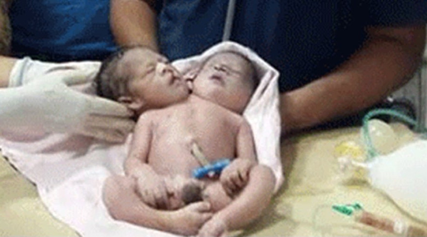 Cận cảnh đứa trẻ có 2 đầu 3 tay