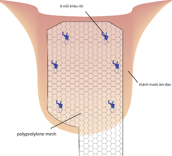 'Đoạn tuyệt' với sa sinh dục - bàng quang nhờ kỹ thuật nội soi hiện đại