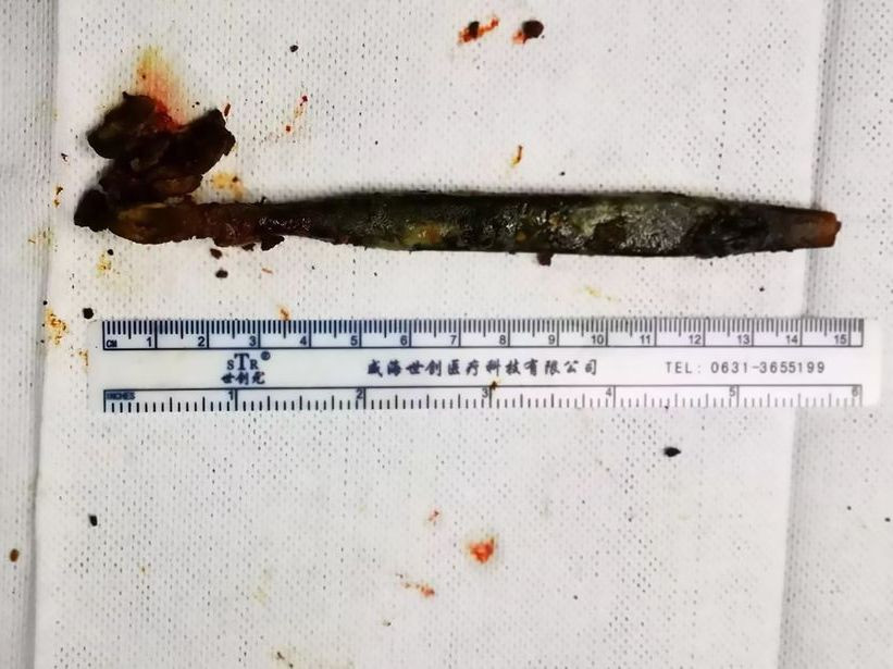  Chiếc bàn chải đã được lấy ra khỏi ổ bụng của Li. Ảnh: AsiaWire