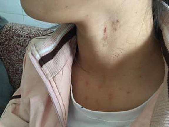 Vết trầy xước trên cổ nạn nhân.