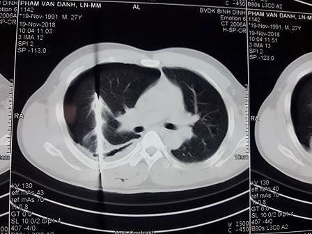 Kết quả chụp phim của bệnh nhân. Ảnh: Bệnh viện cung cấp