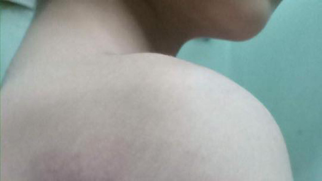 Những vết bầm trên khoảng rộng vai và tay cháu T. Ảnh: Gia đình cung cấp 