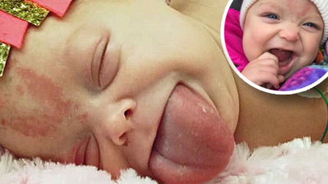 Paisley Morrison-Johnson bị mắc Hội chứng hiếm gặp Wiedemann Beckwith với cái lưỡi gấp đôi bình thường