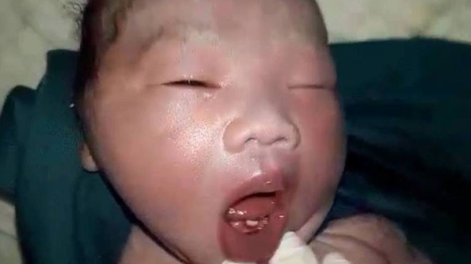 Bất ngờ cháu bé vừa sinh đã có răng cửa