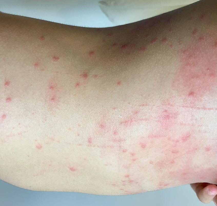 Sau khi tắm biển về, nhiều người bị ngứa, nổi mẩn. Ảnh: Đ.N