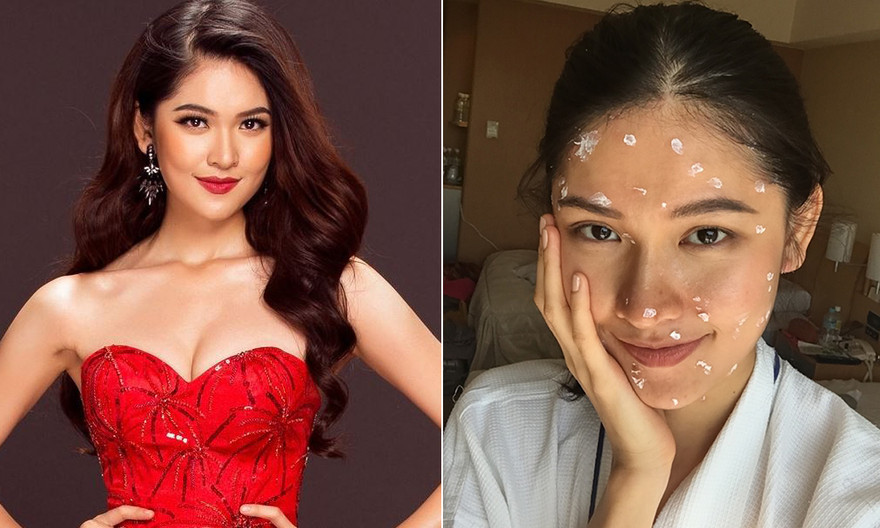 Tuy bị thuỷ đậu nhưng người đẹp vẫn rất lạc quan.