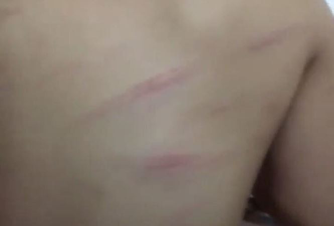 Nhiều vết thương trên lưng em Ng. được gia đình phát hiện