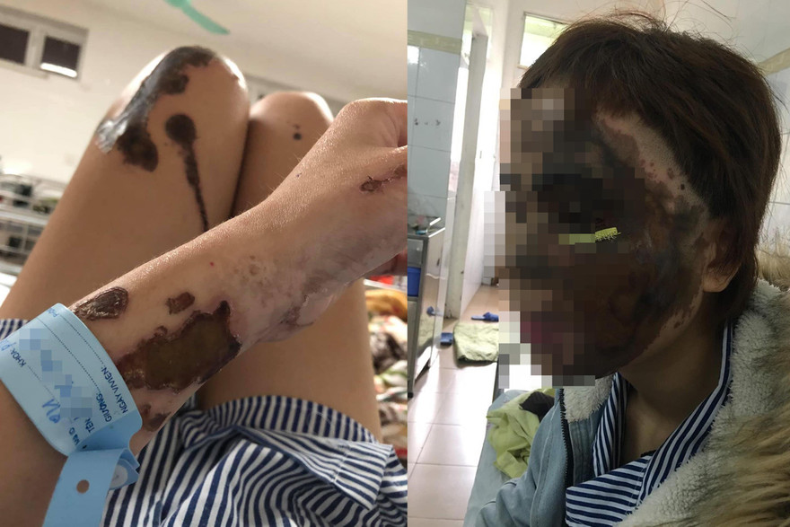 Bị chồng chưa cưới là cựu thiếu úy công an tạt axit, một nửa gương mặt của L.T.L.V bị hủy hoại, cùng với đó là nhiều vết bỏng nặng ở tay, chân