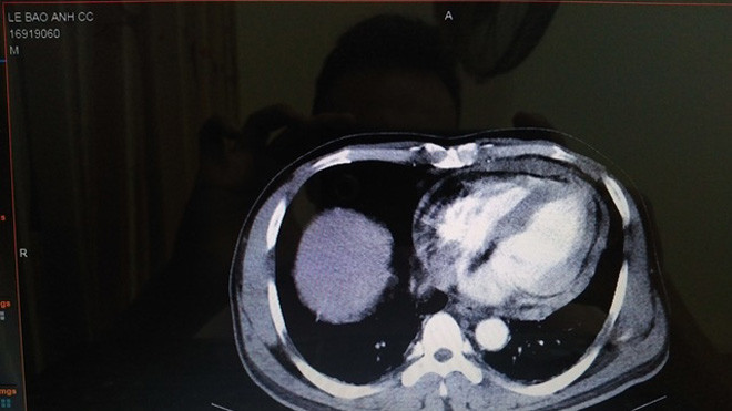 Cứu sống lái xe ôm bị thanh niên đâm thủng tim