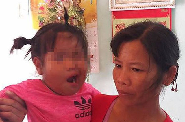 Bé 3 tuổi liệt dây thần kinh số 7 nghi do cô giáo đánh ở Thanh Hóa