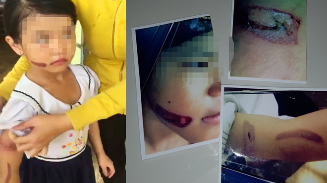  Bé T. với vết thương trên người