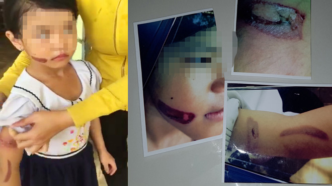Vết thương ở tay và mặt bé T.