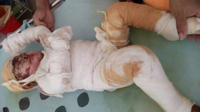 Bé Ngọc băng bó kín người quằn quại trong đau đớn