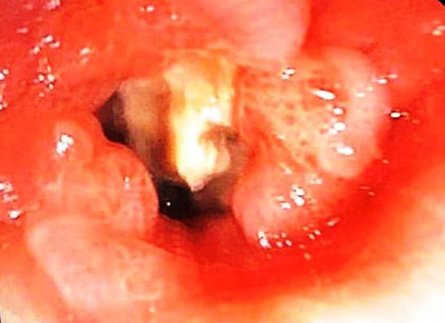Dị vật xương cá thời điểm còn nằm trong phế quản cụ ông 74 tuổi.