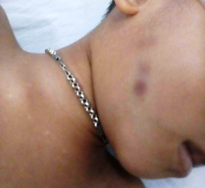 Sức khỏe của cháu L. được tiên lượng rất xấu