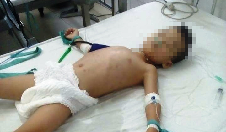 Cháu L. điều trị tại bệnh viện trong tình trạng nguy kịch tính mạng