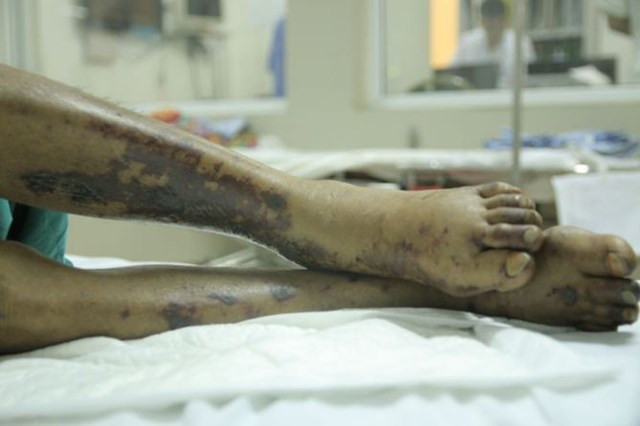 Biểu hiện bên ngoài của bệnh nhân mắc liên cầu lợn. (ảnh minh họa)