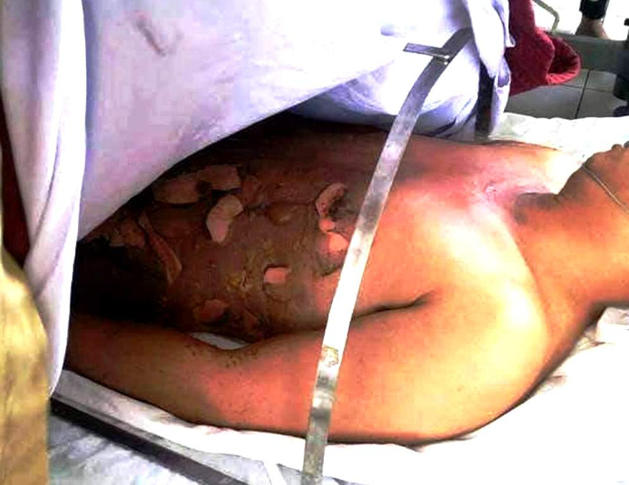 Dừng đổ xăng lẻ ven đường, anh Võ Trọng N. bất ngờ bị cháy sém nửa người với mức bỏng lên đến 30%