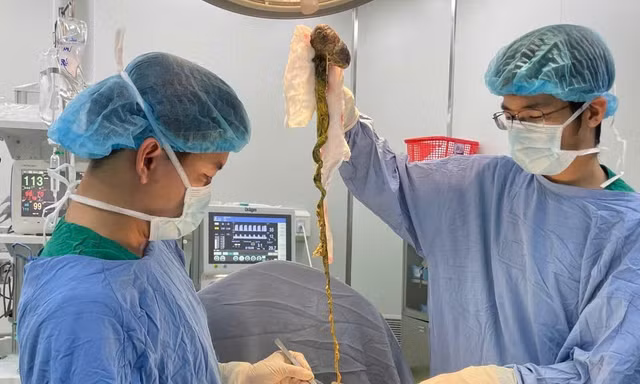Lấy búi tóc khổng lồ ra khỏi dạ dày bé trai ở Đà Nẵng