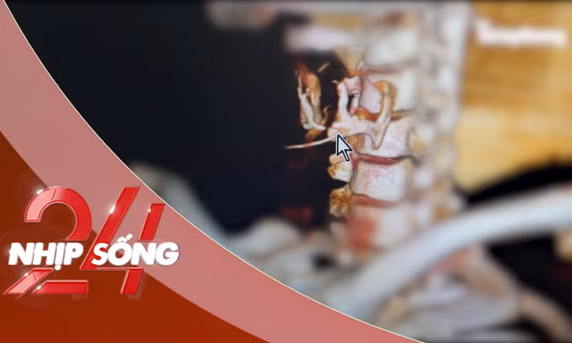 NHỊP SỐNG 24: Cố nuốt cơm chữa hóc xương, người đàn ông 35 tuổi thủng thực quản