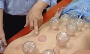 Đột quỵ nặng khi nhờ chị gái giác hơi