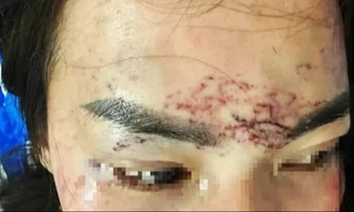 Diễn biến vụ 2 phụ nữ đánh ghen, đổ axit, xăm mặt người khác ở Cà Mau