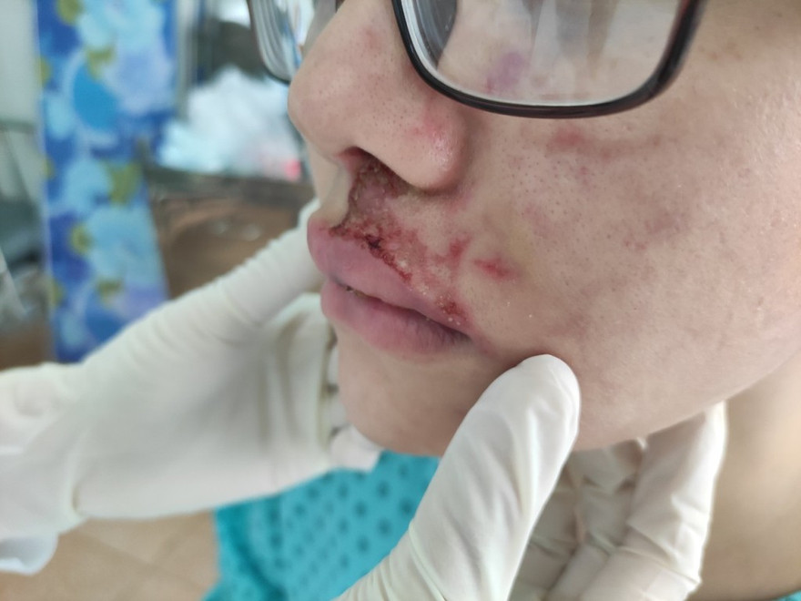 Tiêm filler tại thẩm mỹ viện có giá 3,5 triệu đồng/2 mũi, cô gái sưng phù khuôn mặt (ảnh: BVCC)