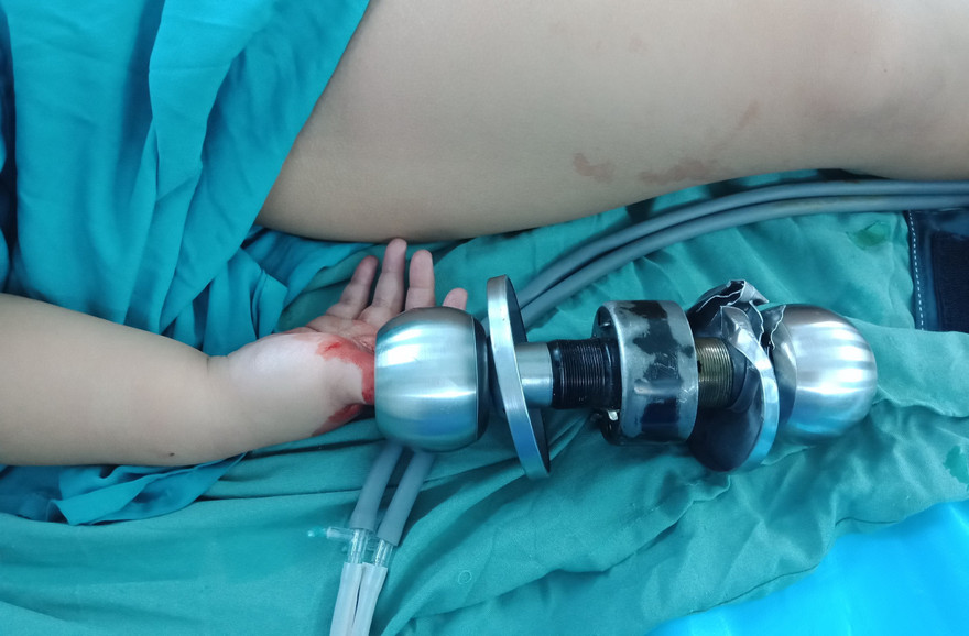 Bé trai 3 tuổi vào viện cấp cứu cùng chiếc ổ khóa