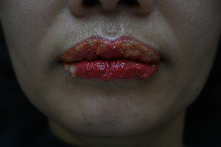 Nhiều phụ nữ bị tai biến làm đẹp khi xăm