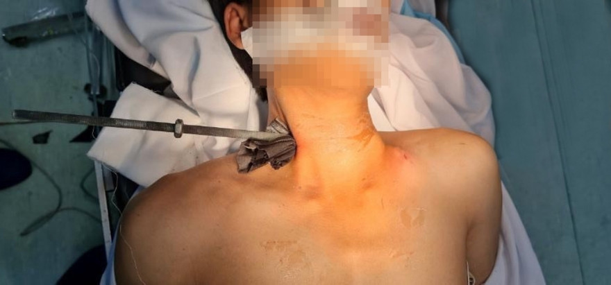 Thanh niên bị cây sắt đâm xuyên cổ (ảnh: BVCC)