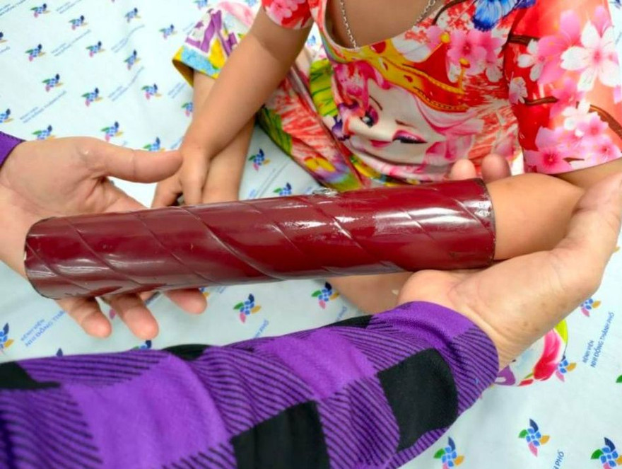 Cô bé chơi trò Iron Man, không ngờ tay kẹt không rút ra được (ảnh: BVCC)